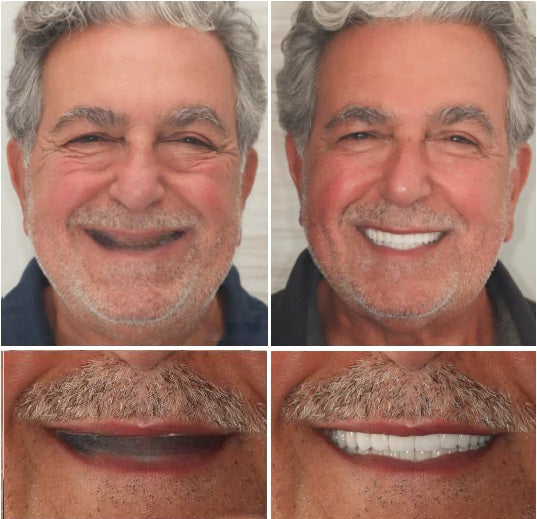 Before and after photo of a model wearing a custom denture, showing restored teeth and natural smile
