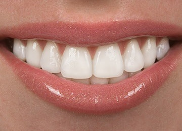 Close-up of flexible ThermoPlas denture highlighting comfort, gum-like flexibility, and natural look