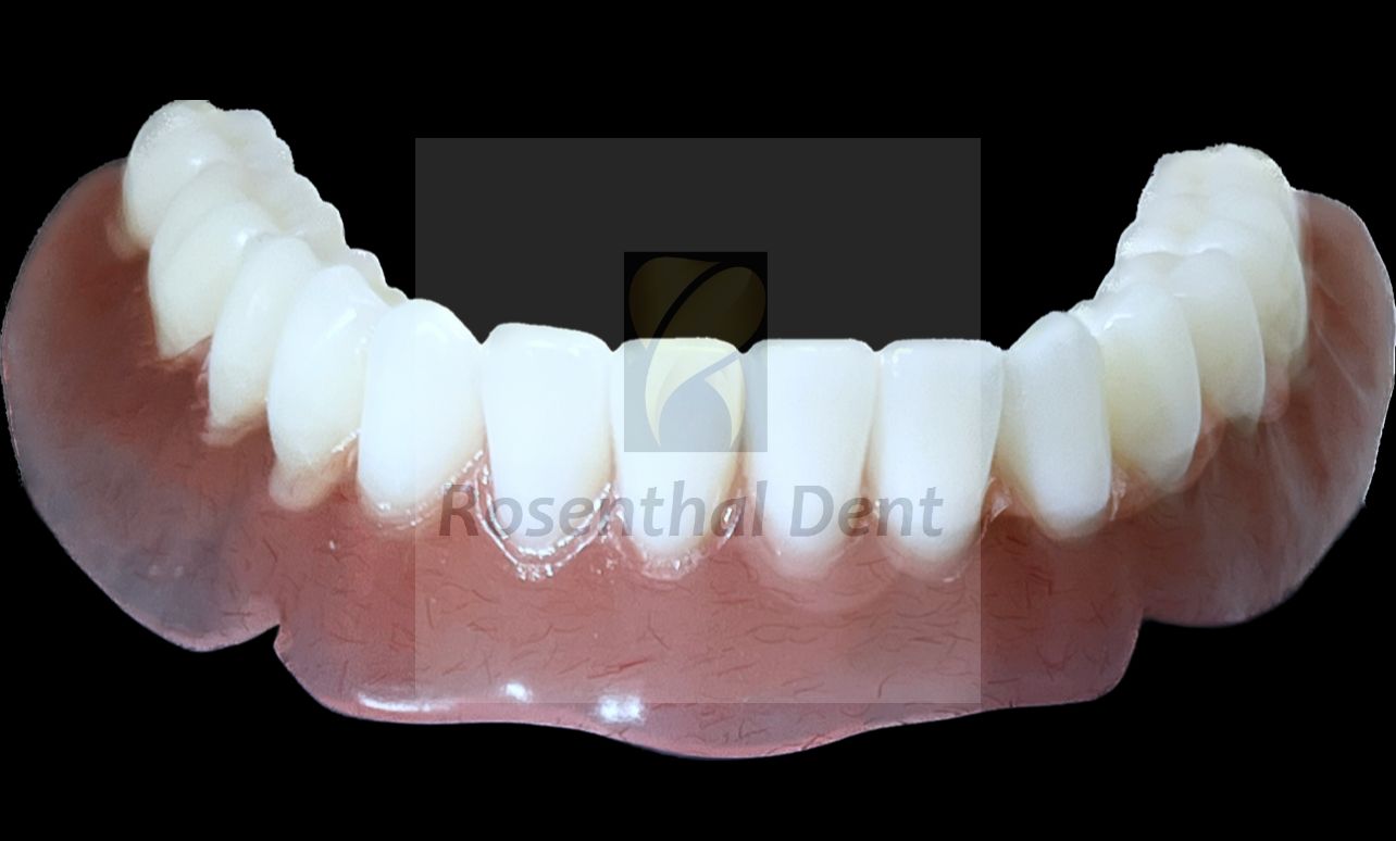 Affordable custom full arch acrylic denture offering durability and comfort.
