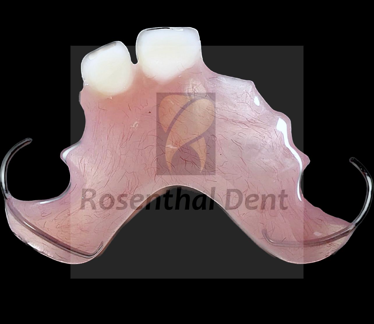 Custom-fit acrylic flipper denture – Ideal for temporary tooth replacement.