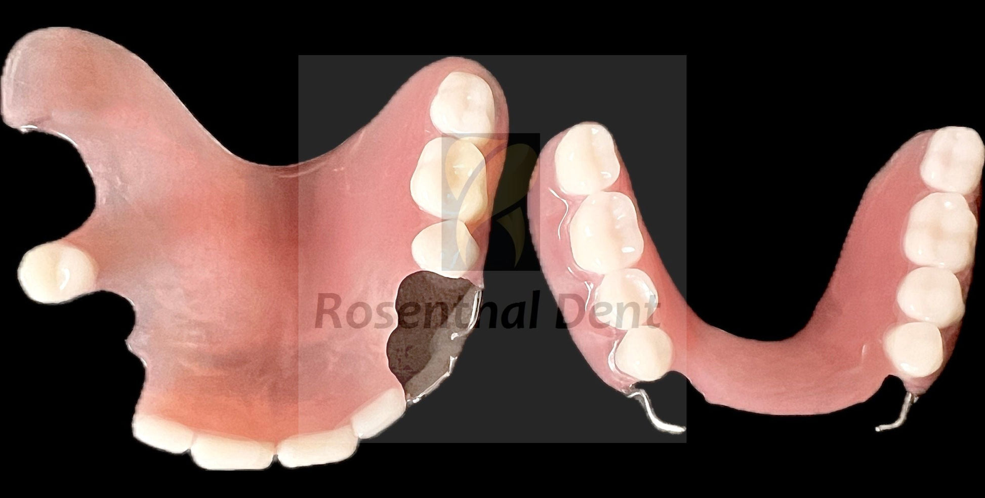 Permanent partial acrylic denture - custom fit for natural aesthetics.
