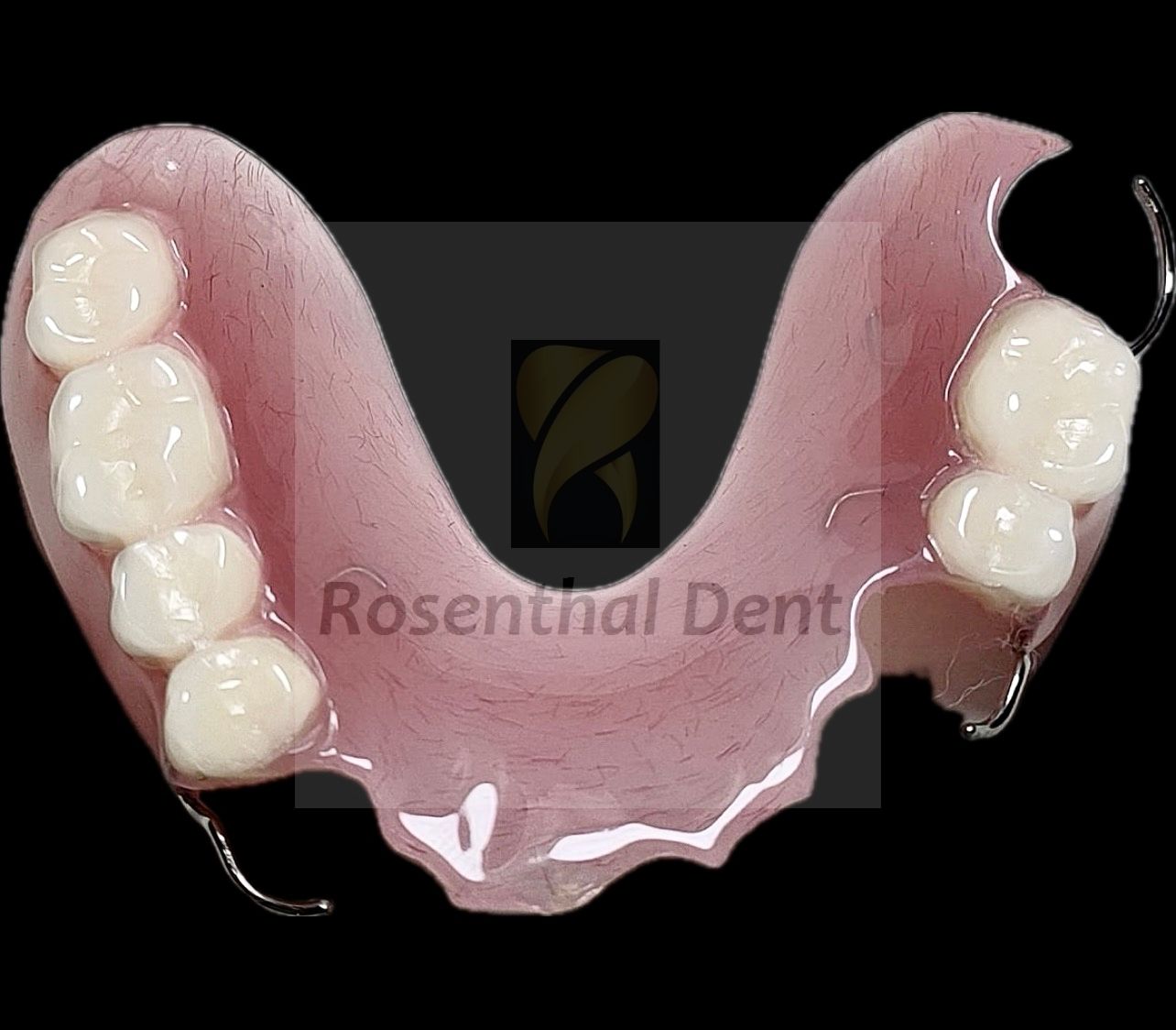Permanent custom acrylic partial denture designed for durability and secure fit.