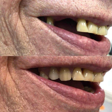 Best Cheap Dentures for Seniors - Comfortable and Budget-Friendly Options at YourDentureStore.