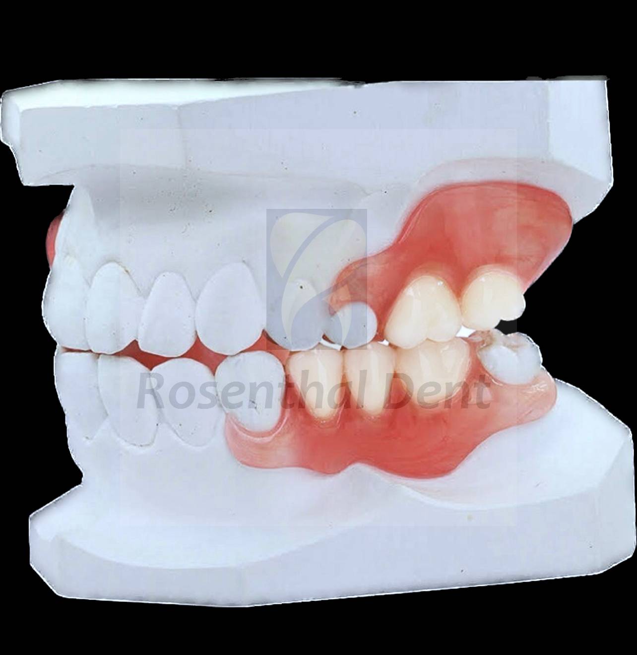 How much do custom partial ThermoPlas flexible dentures cost? Affordable options available.